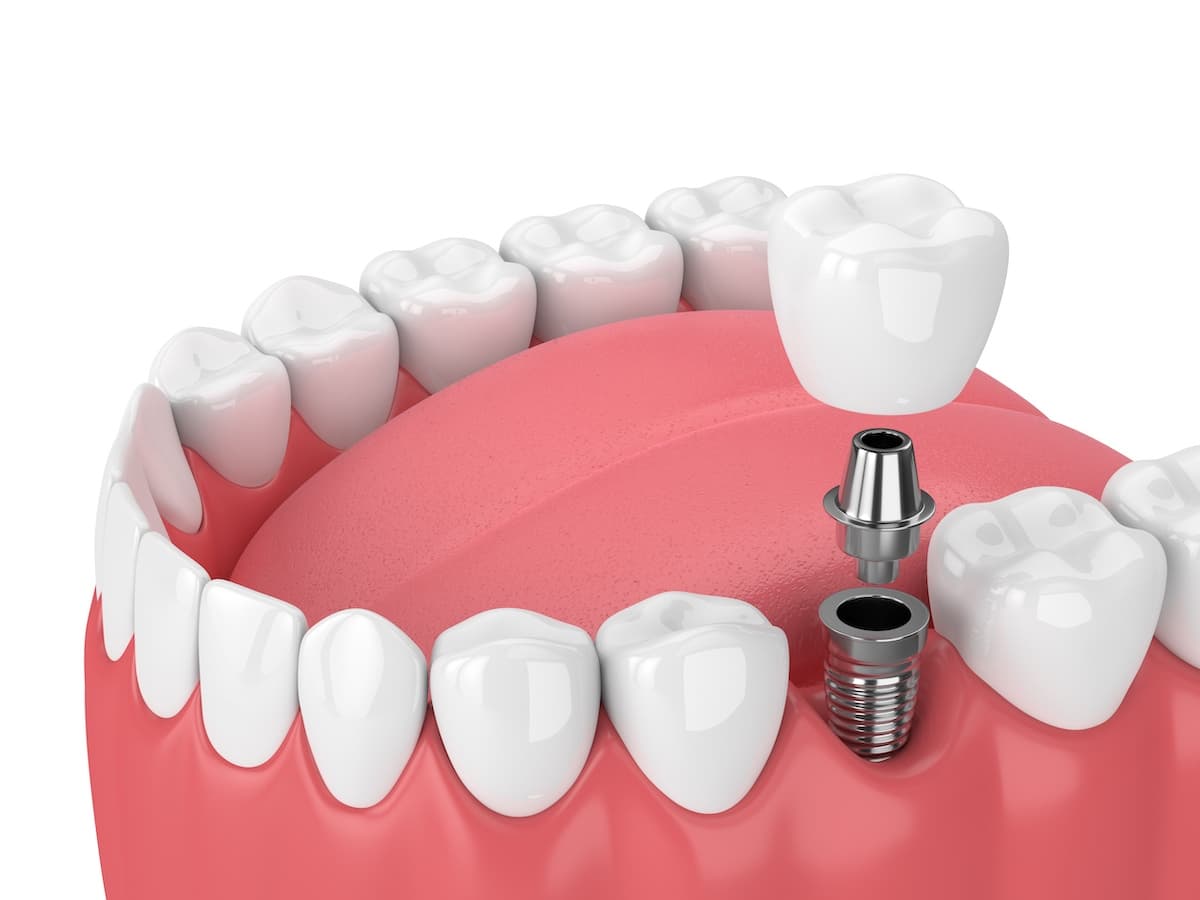 The Silent Threat: Why Gum Disease Should Never Be Ignored