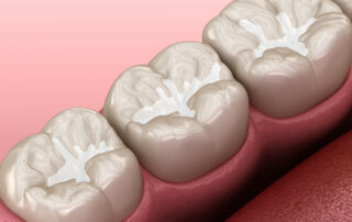 What are Dental Sealants?